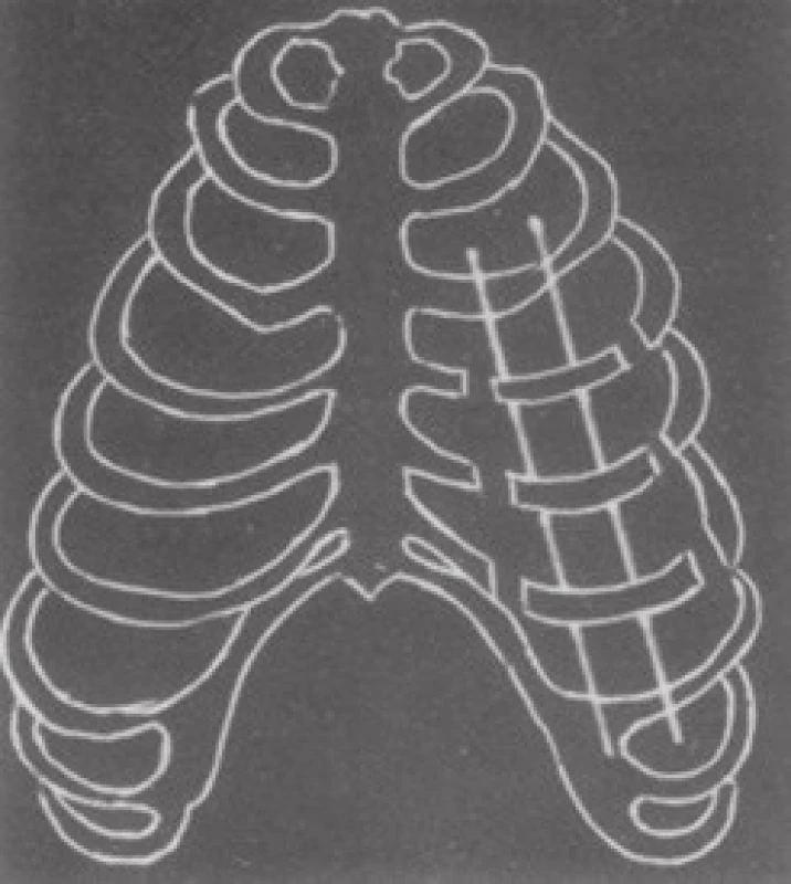 Fixace K-dráty (Beltrami 1978)
Fig. 6: Fixation with K-wires (Beltrami 1978)