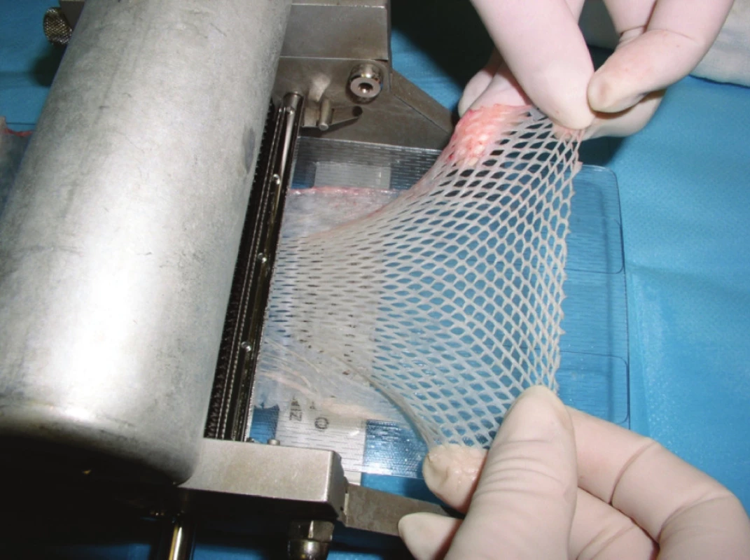 Dermoepidermální autotransplantát meshovaný v poměru 1:2