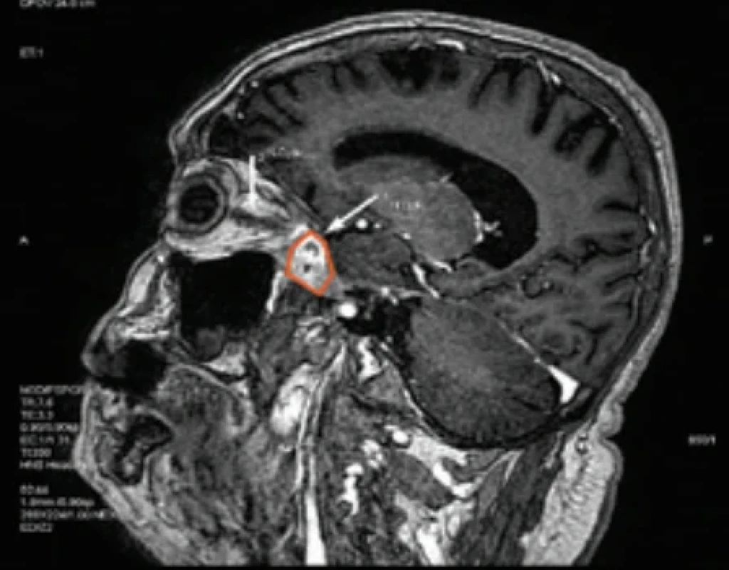 MR obraz mozgu v sagitálnom reze s popisovanou léziou v červenom leme s inváziou do optického kanála (biela šípka). Fig. 2. MR image of the brain in a sagittal section showing the lesion outlined in red, with invasion into the optic canal (white arrow).