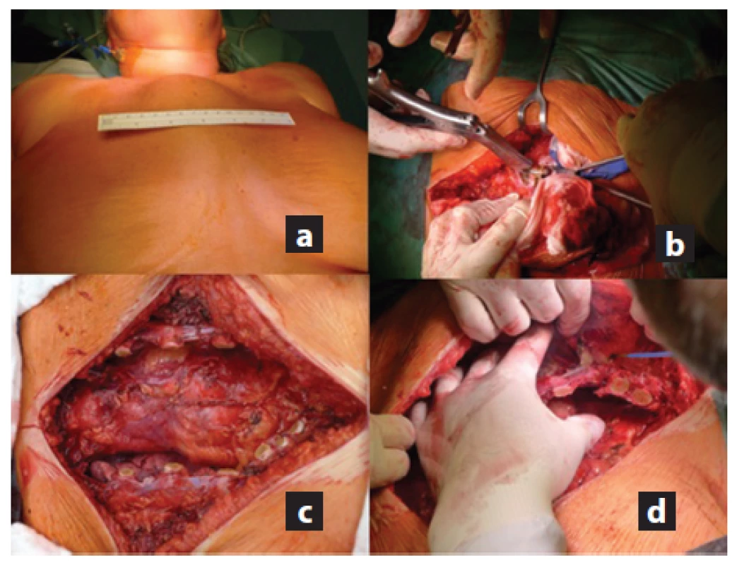 a,b c,d: a) Předoperační snímek zobrazující dobře patrnou ventrálně prominující metastázu sterna; b) Resekce žeber kostotomem; c) Vzniklý ventrální defekt hrudní stěny po resekci sterna; d) Mobilizace pektorálních svalů na okraji defektu.
Fig. 3 a,b,c,d: a) Preoperative image showing ventral skin elevation caused by the sternal metastasis; b) Rib resection with costotome; c) Ventral thoracic wall defect after resection of the sternum; d) Pectoral muscle mobilization
for closure of the defect.