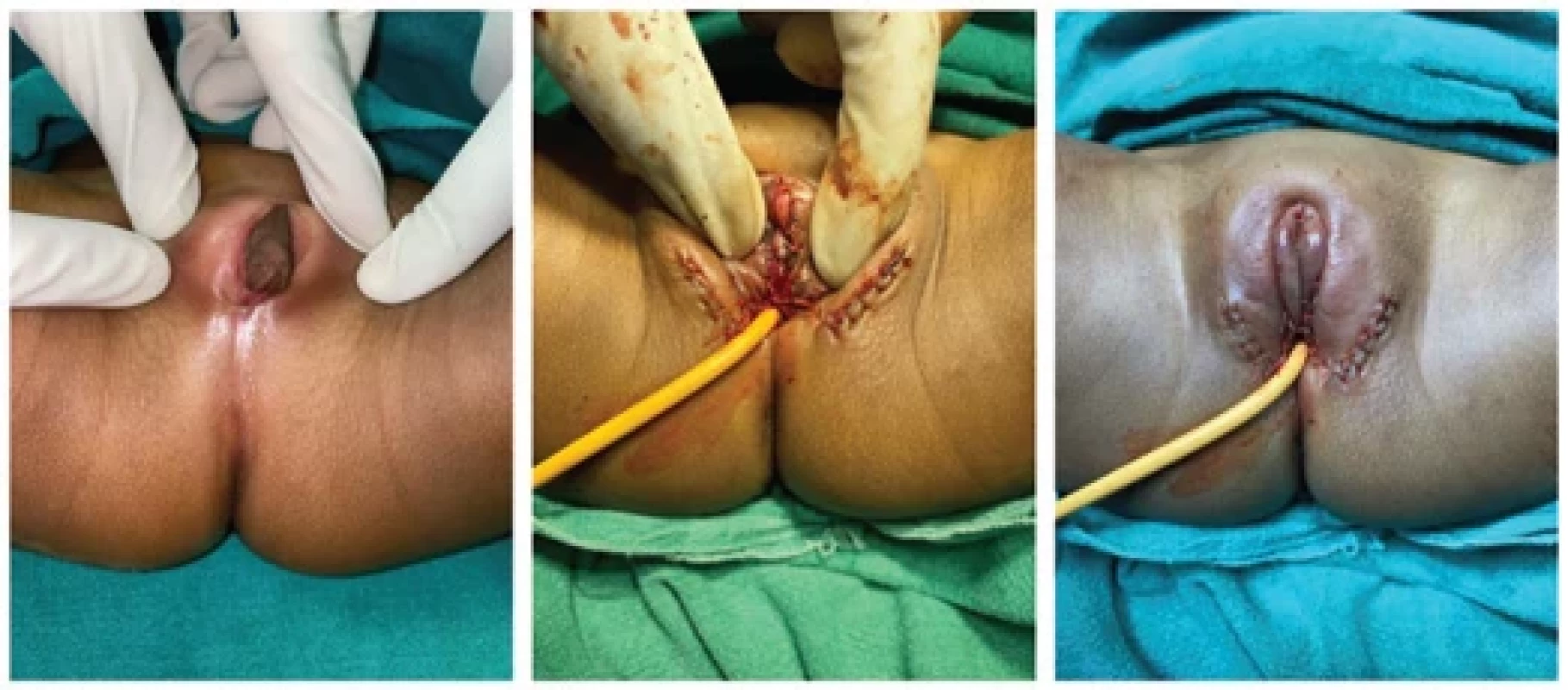 Preoperative and postoperative pictures showing another case of congenital adrenal hyperplasia with ambiguous genitalia.