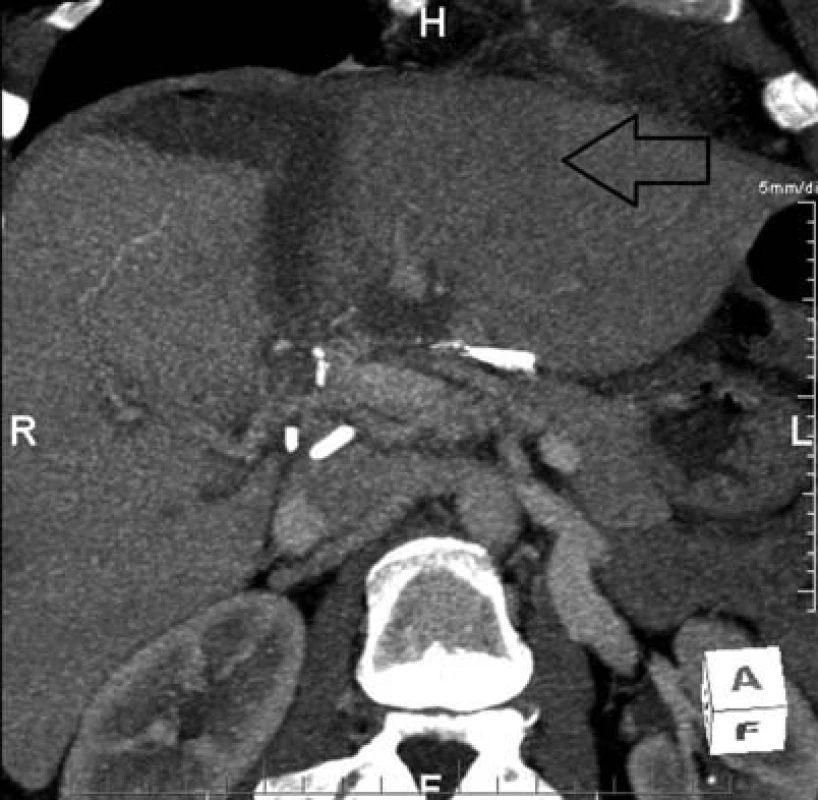 CT obraz hypertrofovaných segmentů S2 a S3 (šipka)
Fig. 4: CT scan with hypertrophy of S2 and S3 segments (black arrow)