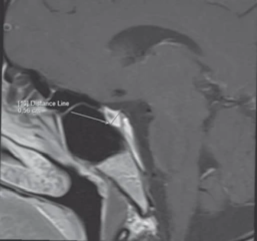 Magnetická rezonancia mozgu 8 mesiacov po pôrode. Prítomný obraz parciálnej empty sella s atrofi ou a cystoidnou degeneráciou hypofýzy – po infarzácii, patrná regresia veľkosti hypofýzy.