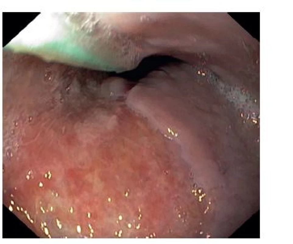 Gastroskopický snímek po 13 dnech s plošnou erozí sliznice
Fig. 4: Upper endoscopy image after 13 days with mucosal surface erosion