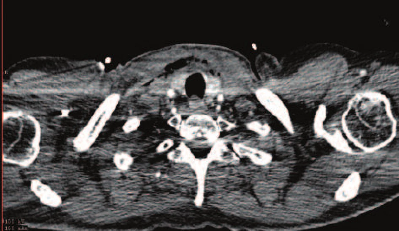 CT obraz prosáknutí měkkých tkání krku a emfyzém
Fig. 1: CT image of the neck soft tissue infiltration and emphysema