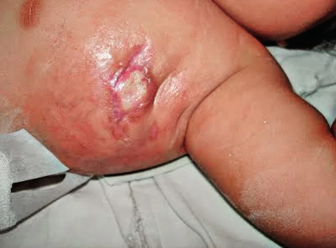 Axilární BCG lymfadenitida u pacientky s deficitem IFNγR1, věk 3 měsíce (první kazuistika).
Fig. 2. Axillary BCG lymphadenitis in IFNγR1 deficient patient, age 3 months (first case).