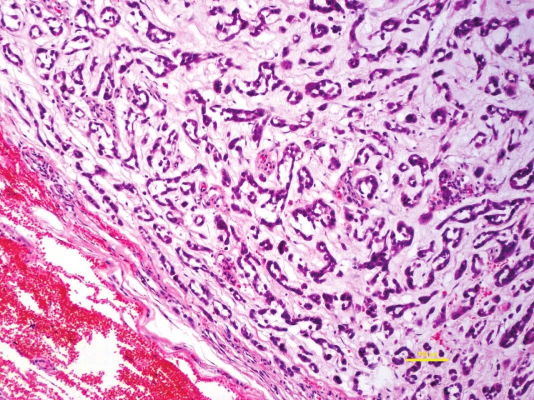 Extraskeletální myxoidní chondrosarkom je méně obvyklá malignita s nejistou histogenezí.