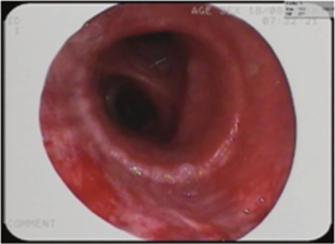 Bronchoskopický pohled: zhojená anastomóza, stav po vytažení stentu
Fig. 7: Bronchoscopic view: healed anastomosis; status after stent extraction