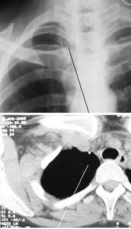 RTG obraz cizího tělesa v horní hrudní apertuře, CT-obraz
Fig. 5. An x- ray view of the foreign body in the upper thoracic aperture, a CT scan