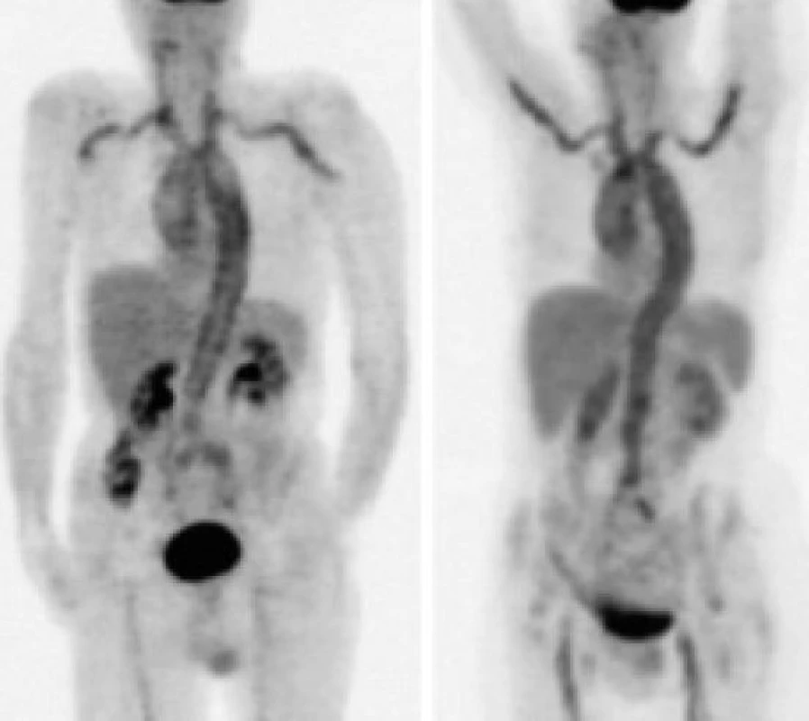 Patologicky zvýšené kumulace 18fluorodeoxyglukózy ve velkých cévách u nemocného s horečkou nejasného původu. Pomocí tohoto vyšetření se prokázala vaskulitida, později verifikovaná histologicky.