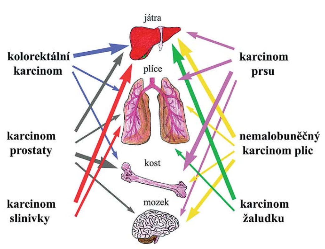 Tkáňový tropizmus.
Různé typy karcinomů a cílové tkáně, do nichž nejčastěji metastazují. Frekvence metastáz je znázorněna sílou jednotlivých šipek.
