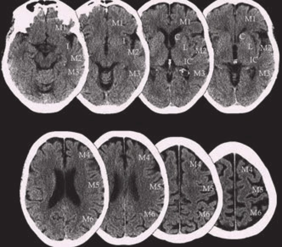ASPECTS (Alberta Stroke Program Early CT Score).