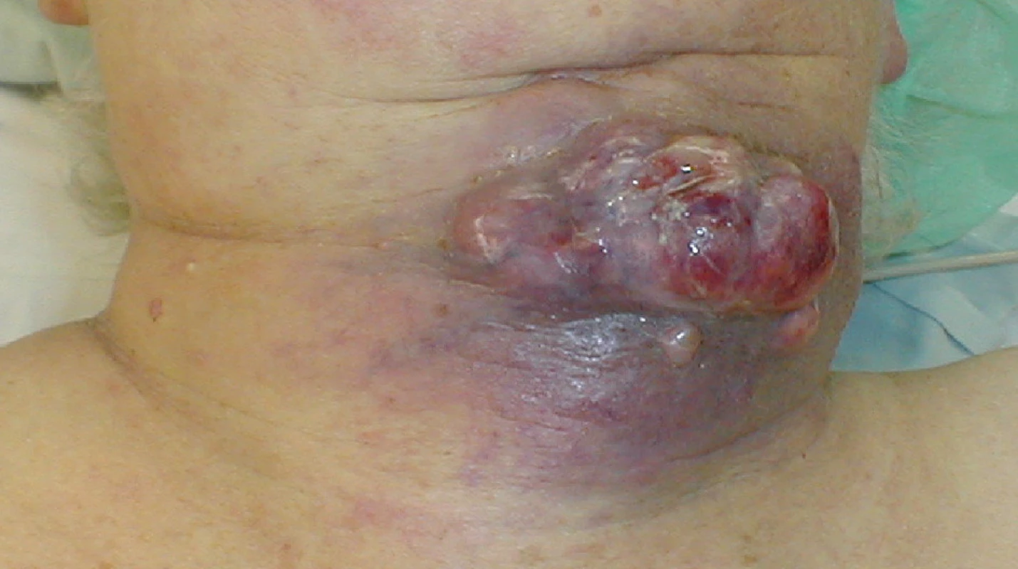 Lokálně pokročilý ATC – prorůstání přes infrahyoidní svaly do kůže
Fig. 1: Locally advanced ATC – invasion through the infrahyoid muscles into the skin