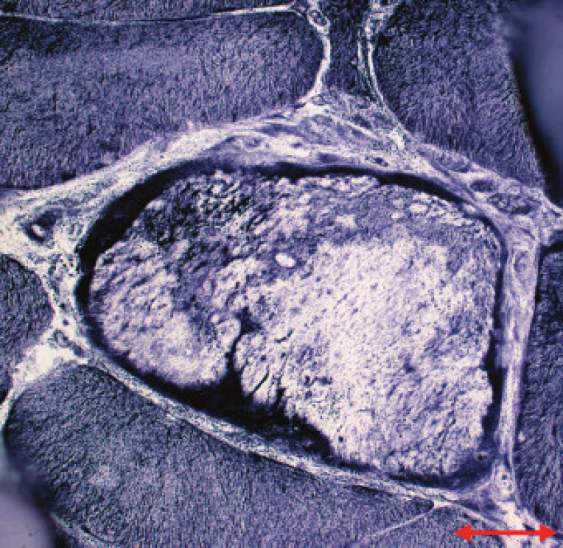 MD1. Sarkoplazmatické masy s intenzivní reakcí na mitochondriální dehydrogenázy na periferii vlákna. NADH tetrazolium reduktáza. Úsečka – 20 μm.