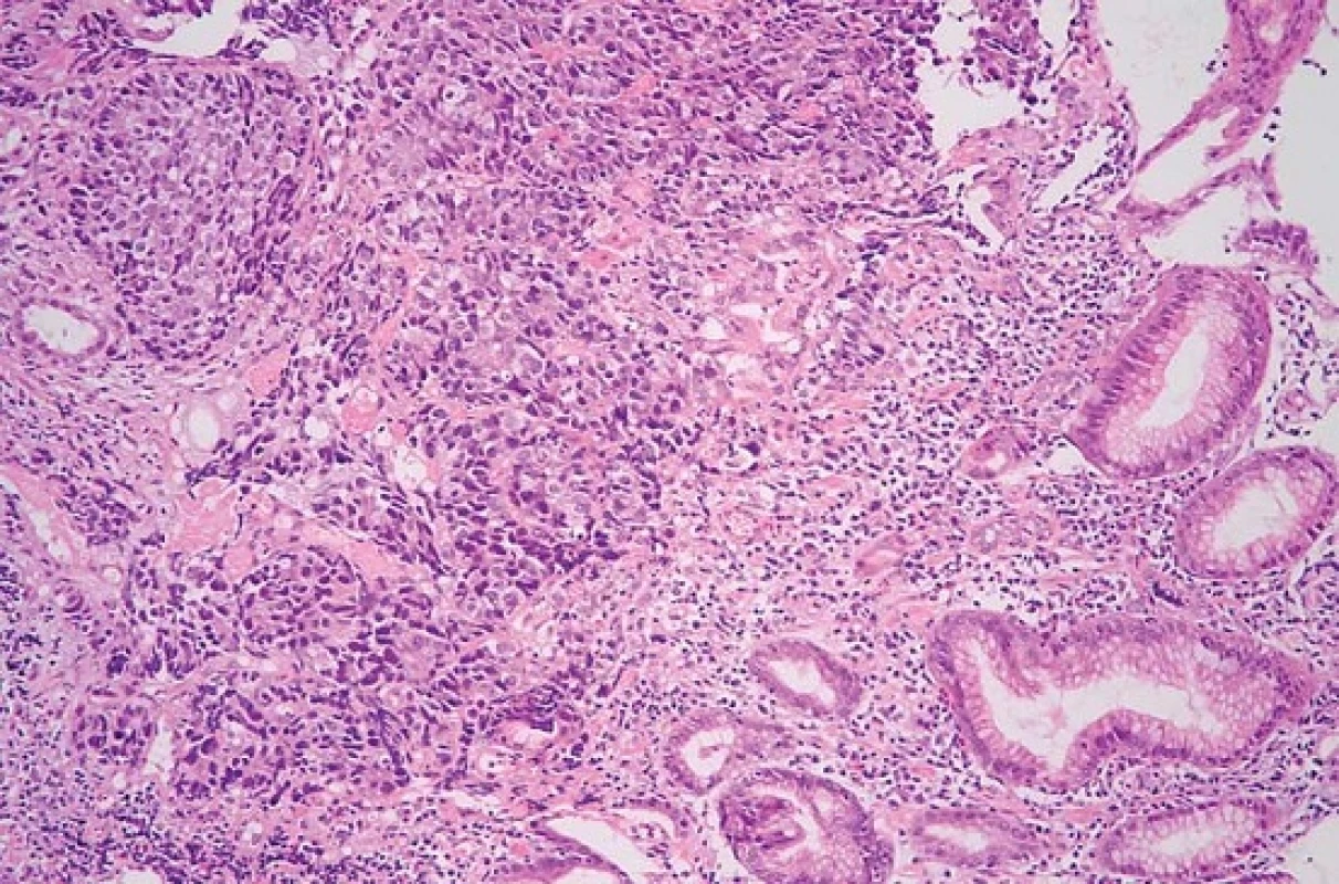 Solidně rostoucí adenokarcinom ve sliznici žaludku (hematoxylin-eozin, původní zvětšení 200×).
Fig. 3. Solid adenocarcinoma in gastric mucosa (haematoxylin-eosin, original magnification ×200).
