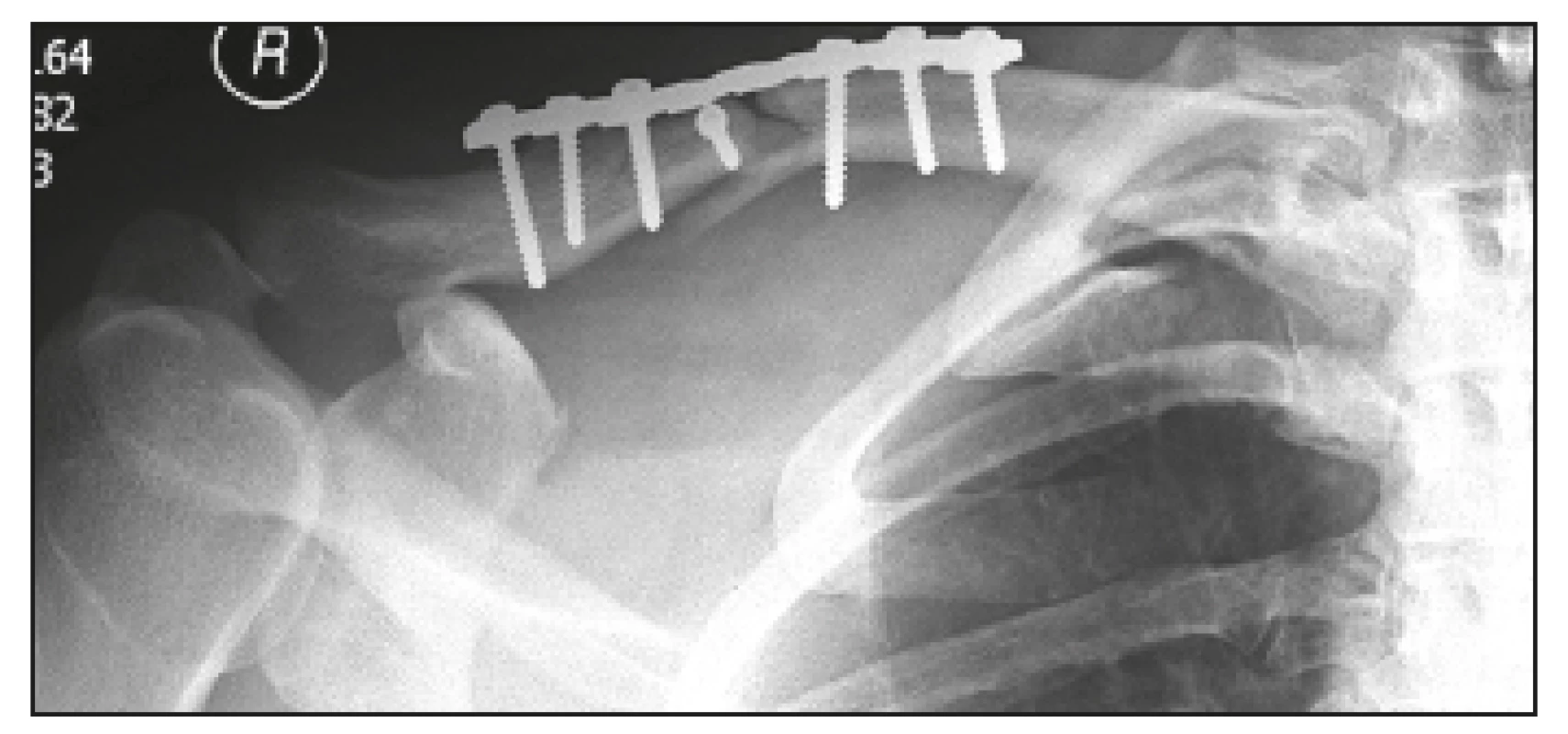 Osteosyntéza podle principu „absolutní“ stability použitím jednotlivého kompresního šroubu 3.5 mm, kde došlo během ukončení montáže dlahy k dislokaci fragmentu