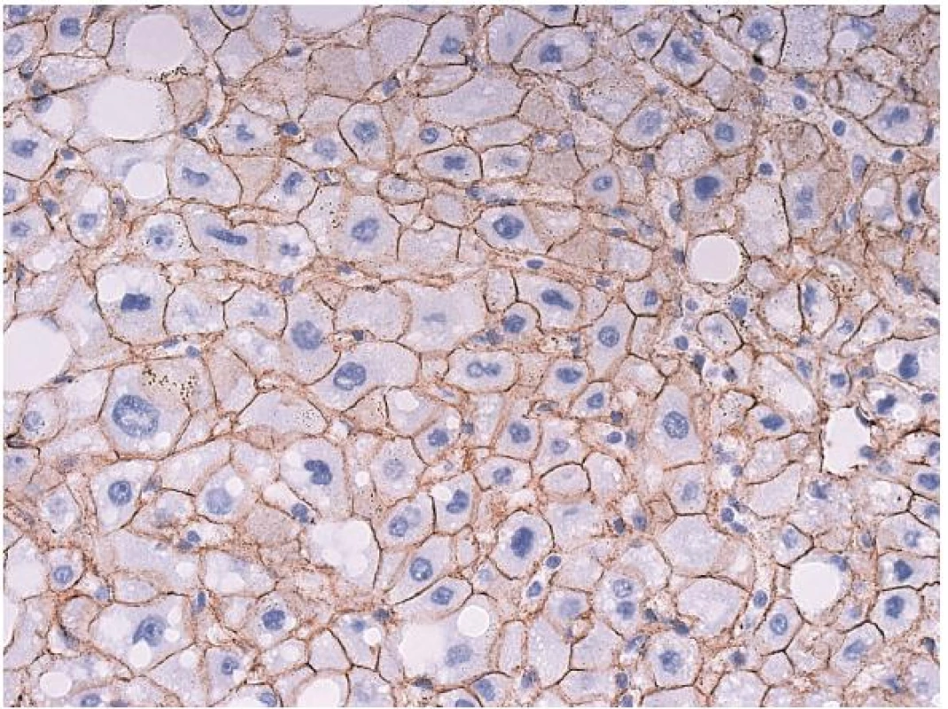 Imunohistochemický průkaz β-cateninu s normální membránovou pozitivitou.