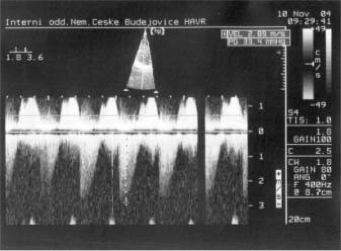 Trikuspidální ústí – CW Doppler: dagger shaped waves – známka těžké regurgitace.