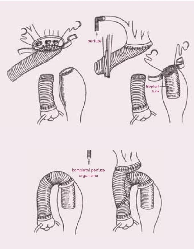 Úplná náhrada aortálního oblouku s použitím metody "elephant trunk".
