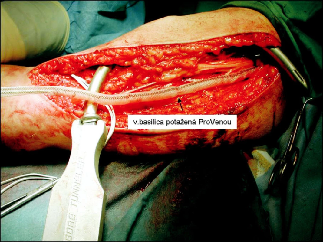 Aplikace zevní protézy na basilickou žílu
Fig. 3. Application of the external prosthesis to the basilic vein