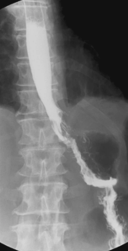 Kontrolní pasáž po konzervativní léčbě 21. den od operace bez průkazu píštěle
Fig. 2. Control passage view following conservative therapy on postoperative Day 21, no fistula detected