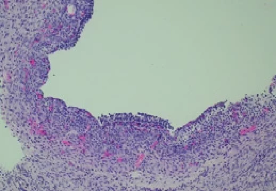a. Histologický řez kortikální tkáně vaječníku před zamražením – antrální folikl (barevní HE, 100×). Fig. 12a. Histological section of ovarian cortical tissue before cryopreservation – antral follicle (HE staining, 100×). HE – hematoxylin a eozin