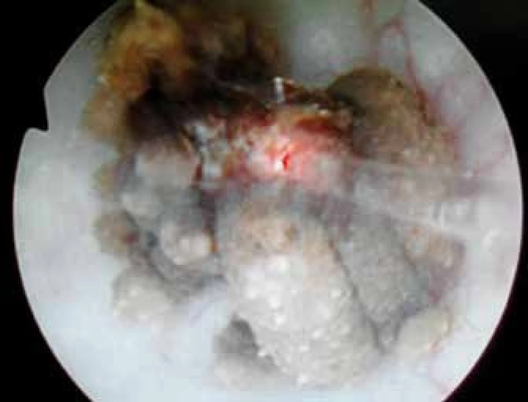Trypse s Ho:YAG laserem
Fig. 2. Ho:YAG laser tripsy