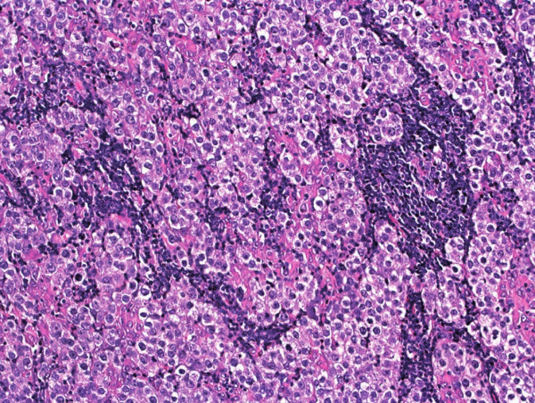 Histologický obraz nádoru z retroperitonea svedčil pre metastázu seminómu do lymfatickej uzliny, s typickými zhlukmi svetlých atypických buniek s jasnými bunkovými membránami, oddelenými fibrovaskulárnymi septami s lymfoidnými infiltrátmi (zväčšenie 100×; farbenie hematoxylín – eozín)
Fig. 4. Histologically, retroperitoneal tumour represented a metastasis of seminoma into lymph node and was composed of clusters of atypical large cells with clear cytoplasm and distinct cell membranes, separated by fibrovascular septa with lymphoid infiltrates (magnification 100×; hematoxylin – eosin staining)