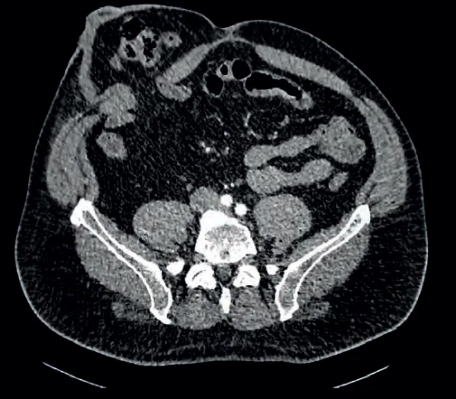 Nález na počítačové tomografii u pacienta s parastomální hernií po otevřené radikální cystektomii s použitím ileálního konduitu. Fig. 2. Computed tomography finding in a patient with parastomal hernia following open radical cystectomy with ileal conduit.