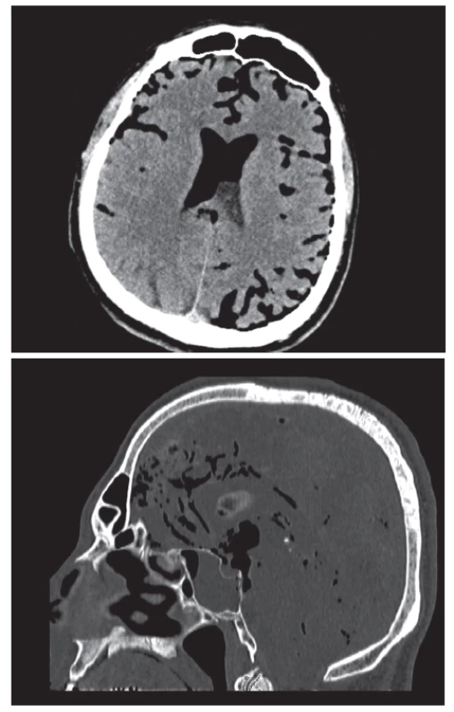 CT vyšetření při příjmu: pneumocefalus
Fig. 1: CT scan after admission: pneumocephalus
