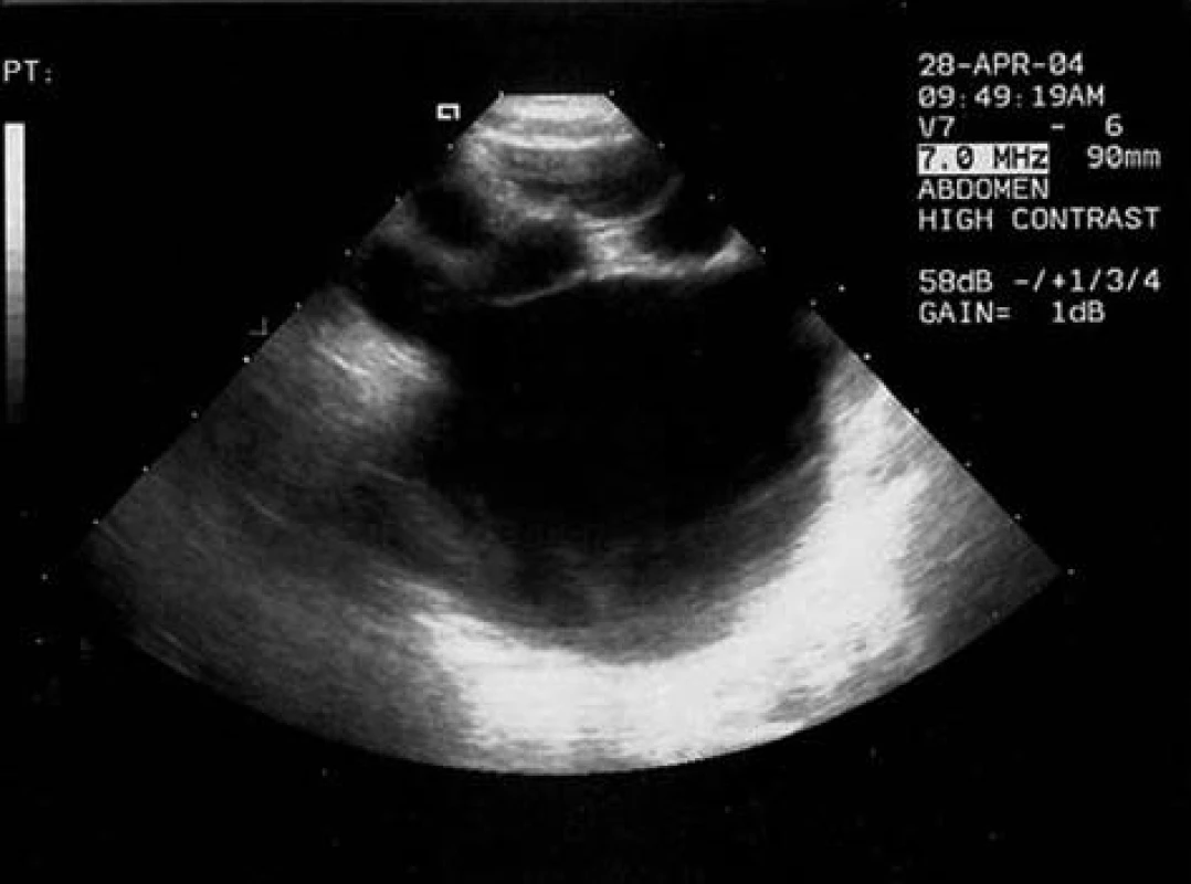 Hydronefrotický typ MCDK – průkaz jedné velké cysty s malými cystami v okolí.
Fig. 2. Hydronephrotic type of MCDK – demonstration of one big cyst with small cysts in the neighborhood.