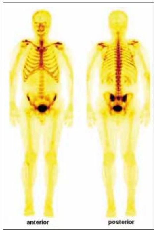 Celotělový scintigram skeletu (srpen roku 2009) ukázal abnormálně zvýšenou aktivitu radiofarmaka v celém hrudním koši (včetně chrupavčitých částí žeber, sterna a klavikul). Nehomogenně vyšší aktivita byla dále popsána v proximálních polovinách obou humerů, v distální třetině levého femuru a v proximální polovině obou tibií. Vysoká aktivita radiofarmaka je rovněž patrná v kosti křížové a v oblasti obou sakroiliakálních skloubení.