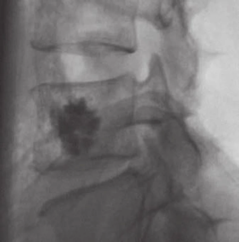 Bipedikulární vertebroplastika těla L4, postiženého agresivním hemangiomem obratle.
