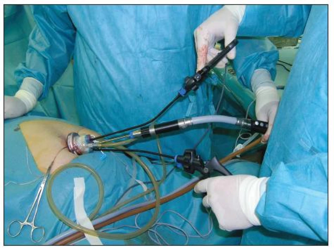 Asymetrické endoskopické nástroje (LESS)
Fig. 3. Asymetric endoscopic instruments (LESS)