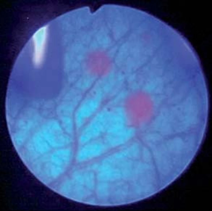Fluorescentní cystoskopie.