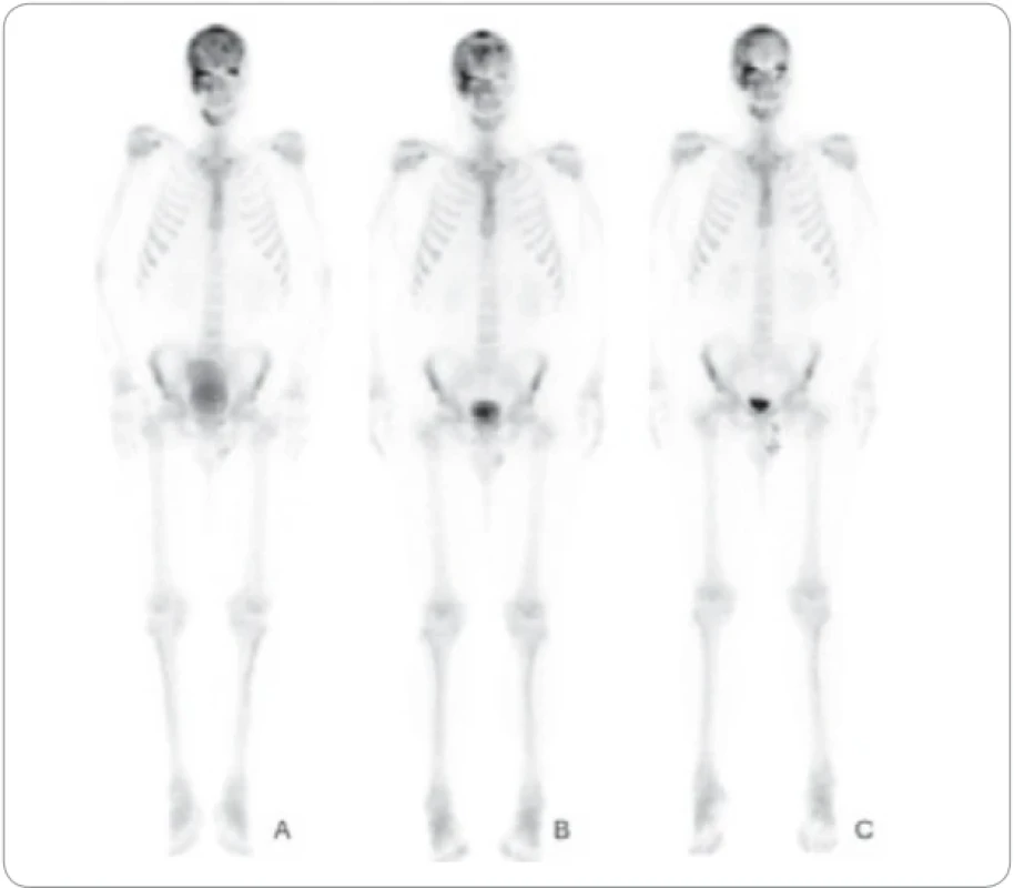 Scintigrafie skeletu pomocí 99mTc-HDP (oxidronátu).