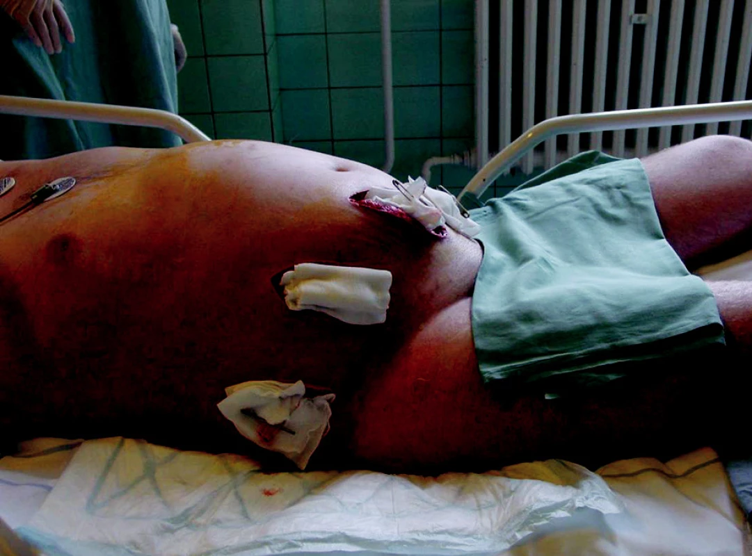 Extenzivní drenáž břišní stěny
Fig. 2. Extensive abdominal wall drainage