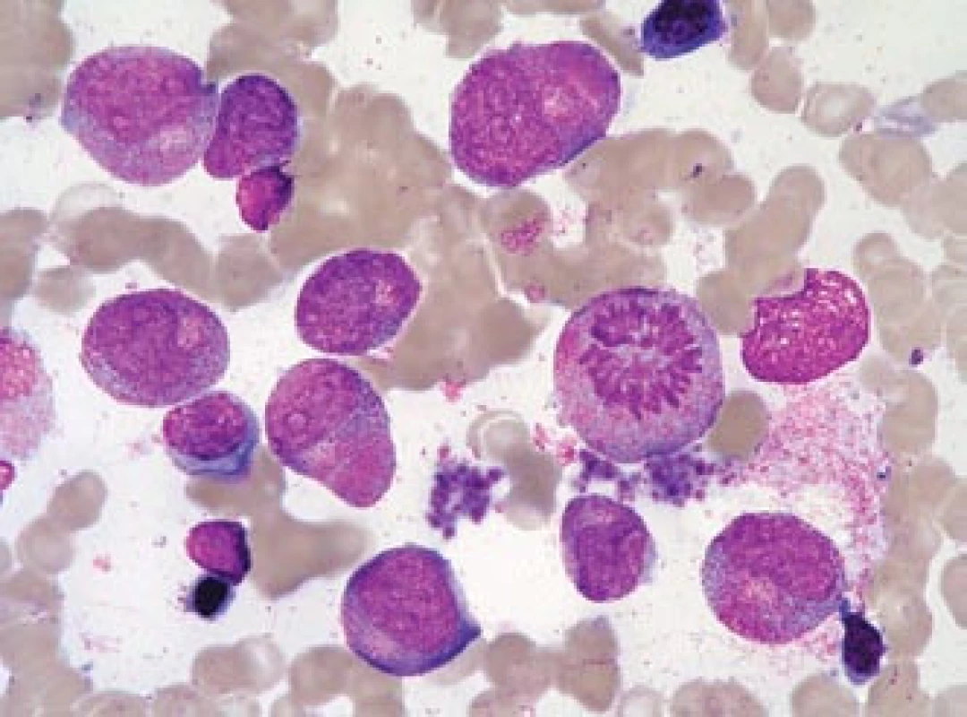 Leukemoidní promyelocytární reakce. 