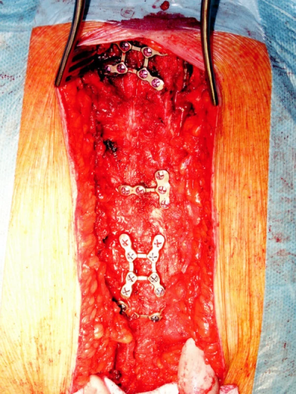 Výsledný stav po implantaci kostěných dlah SternaLock ® systému
Fig. 6. Outcome of the SternaLock® bone casts implantation