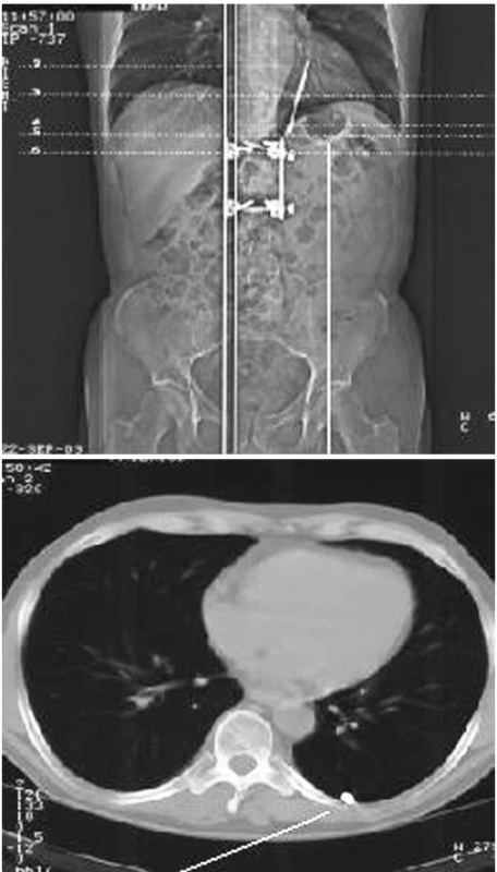 CT obraz cizího tělesa v pleurální dutině
Fig. 3. A CT view of a foreign body in the pleural cavity