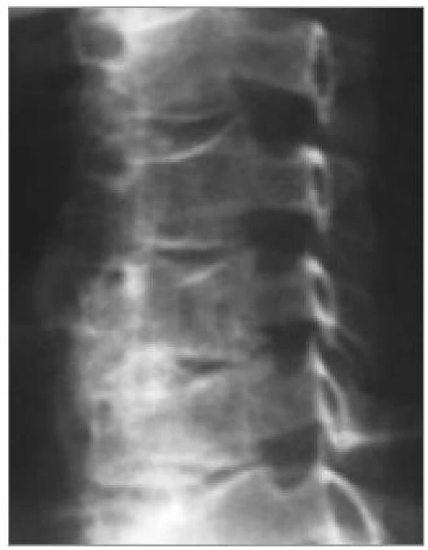 Šikmá projekce: stenóza foramen intervertebrale způsobená unkovertebrální neoartrózou.