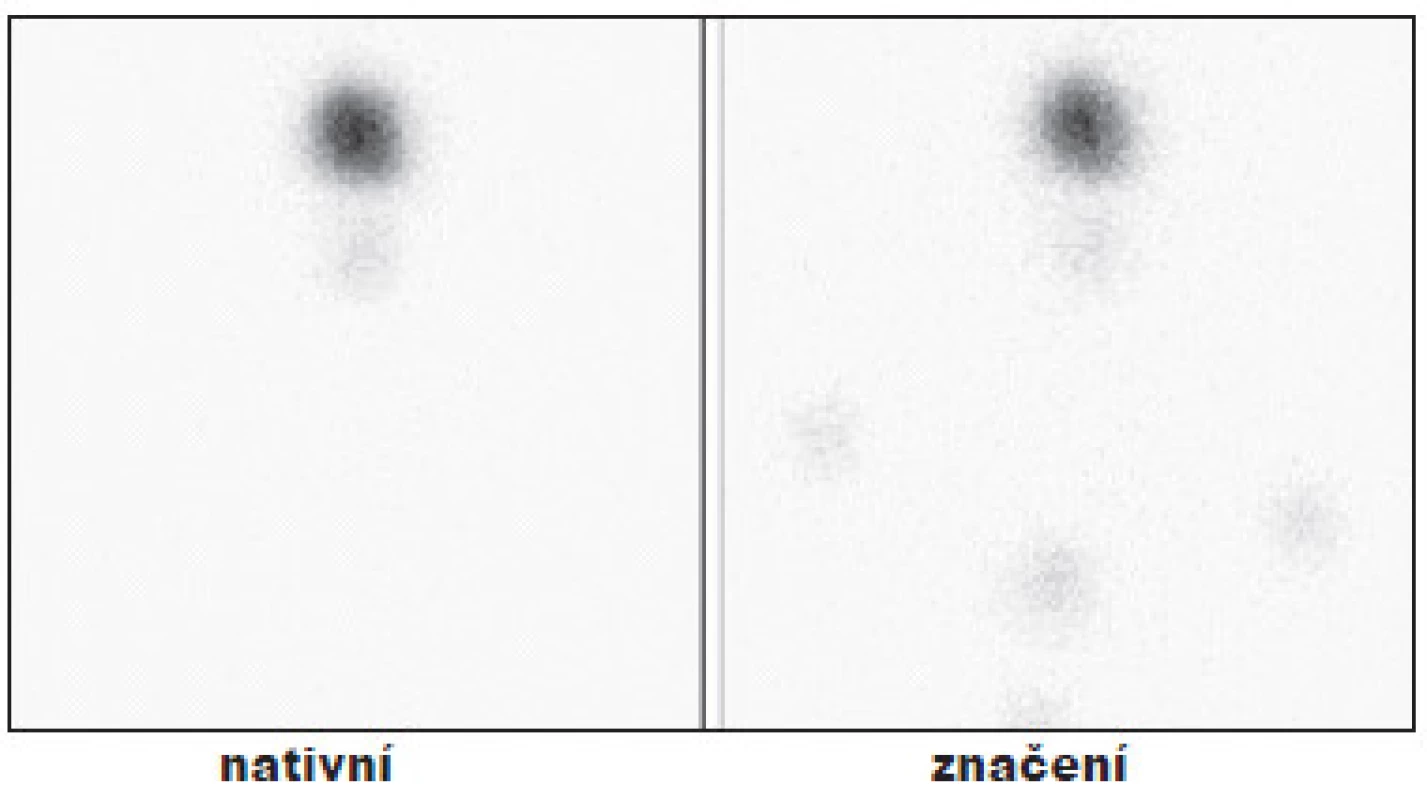 Příklad úspěšné TERJ.
Vysvětlivky: nativní - stav po nTTE, drobné okrsky tyreoidální tkáně v oblasti lobus pyramidalis; značení - scintigram stejné oblasti se značkou v místě jugula a nad ním se značením jizvy po nTTE, hladina Tg 1,1 μg/l, (při scintigrafii za 6 měsíců již bez reziduální tkáně).