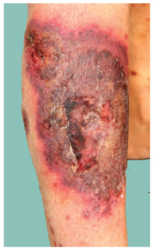 Projev na lýtku charakteru pyoderma gangrenosum