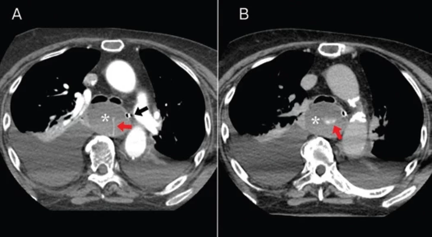 Intramural esophageal hematoma with active leak at CT scan.