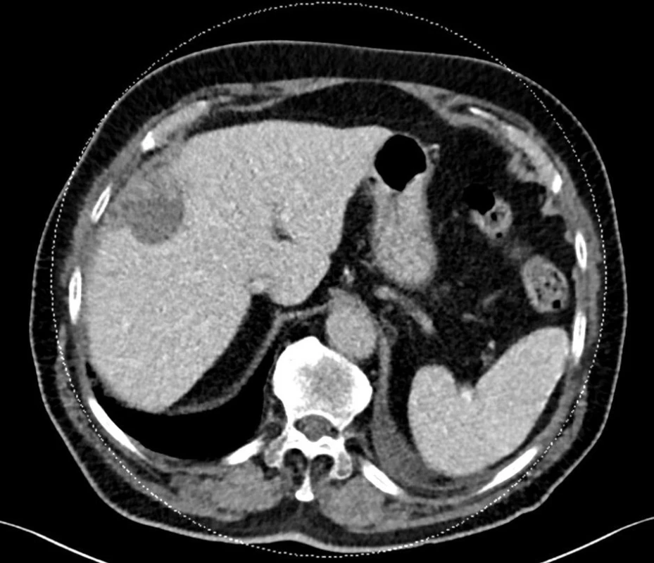 Výpočetní tomografie za 11 měsíců po TACE DEB, nekróza ložiska, redukce objemu.
Fig. 3: Computed tomography image 11months past TACEDEB, nodule necrosis, reduction of volume.