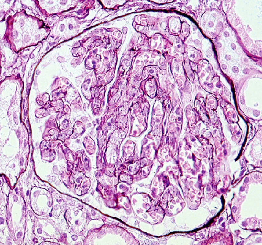 Silně překrvený glomerulus s dilatovanými kapilárními kličkami vyplněnými krví
(barvení PASM [periodic acid – silver methenamine]; objektiv 40krát)

