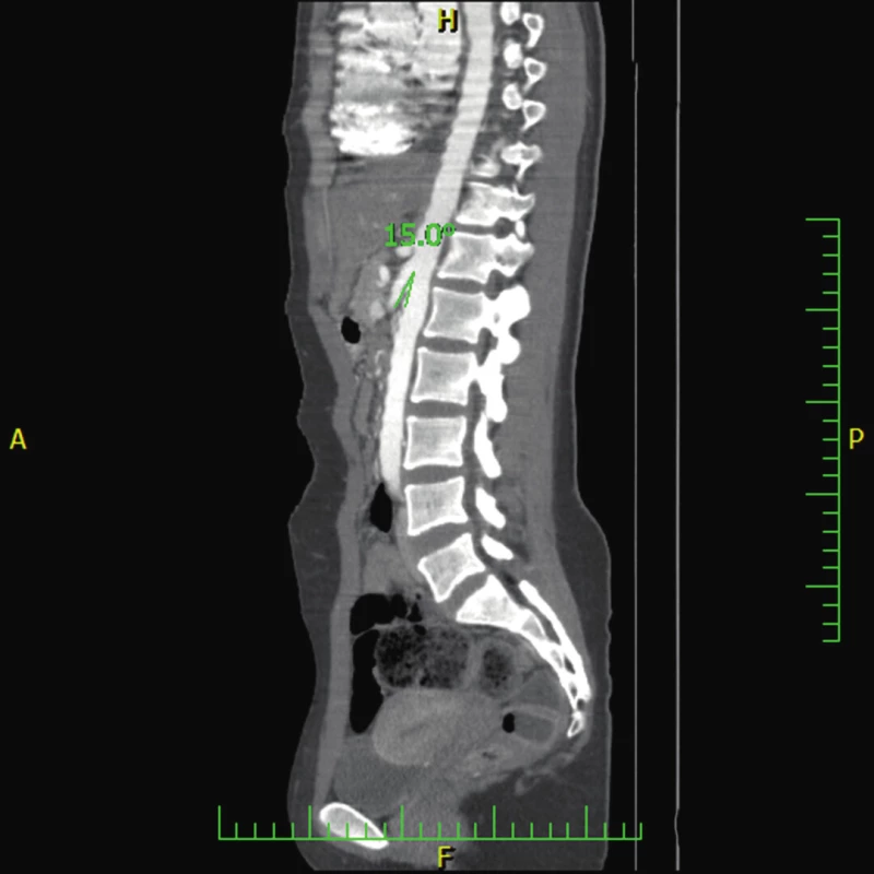 CT angiografie ukazující zjevné snížení úhlu mezi aortou a horní mezenteriální arterií u pacienta 2 (15°). (Obrazový materiál Oddělení radiologie Nemocnice Karviná, MUDr. Kupková).
Fig. 5. CT angiography showing signifiant narrowing of the angle between the abdominal aorta and the superior mesenteric artery (measuring 15°) (case report two).