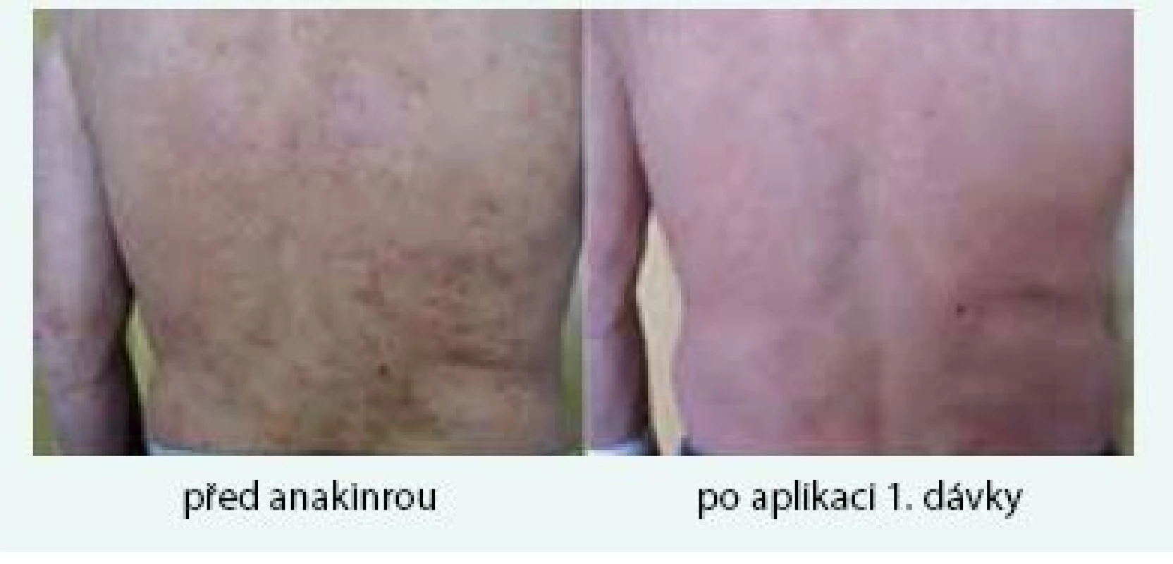 Třetí pacient s kopřivkovými morfami a jejich vymizení po první aplikaci anakinry