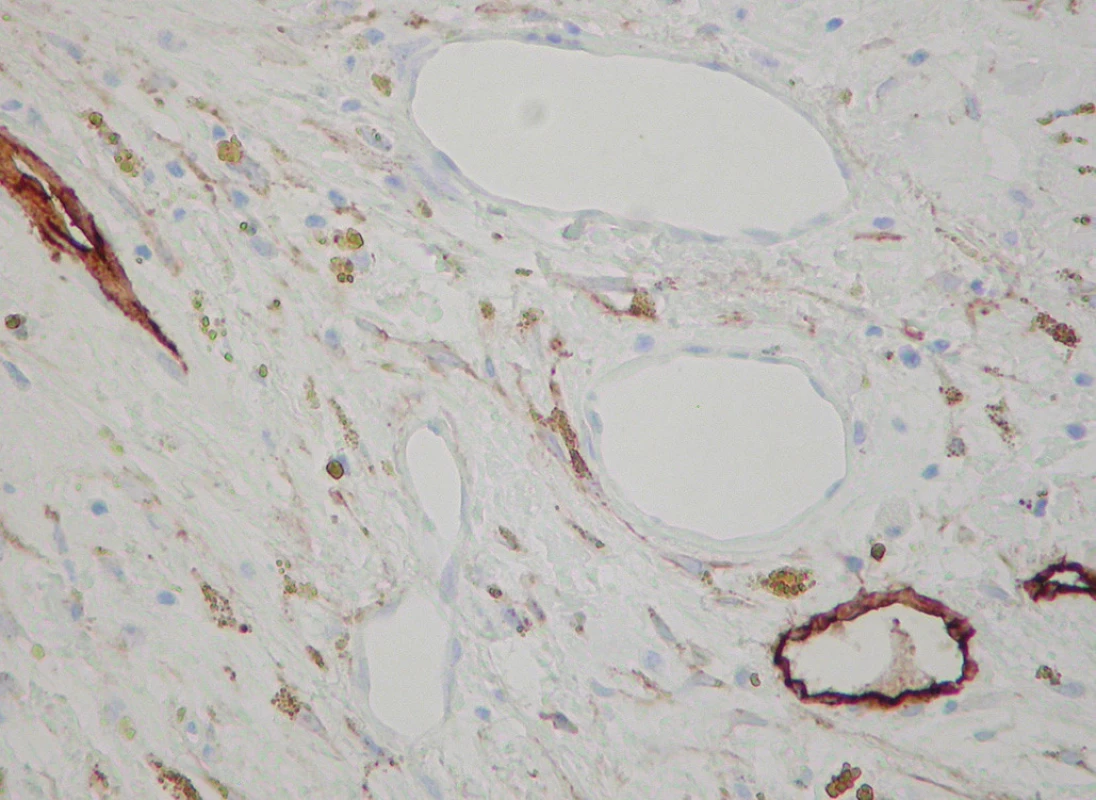 D2-40+ lymphatics intermingled with negative blood vessels