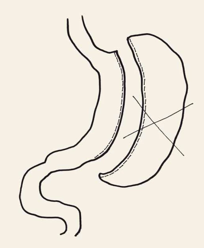 Rukávová resekce žaludku.
Fig.1. Sleeve gastrectomy.
